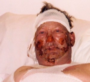 2006-05-09-close-up-bruce-jack-in-hospital-after-his-methane-ethane-contaminated-water-well-exploded