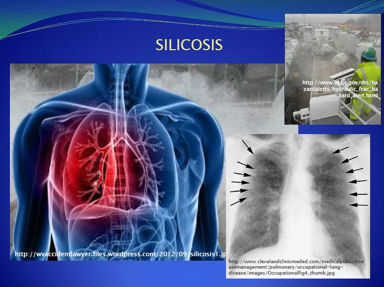 2013 09 Dr. Larysa Dyrszka Environmental Stressors to workers Silicosis