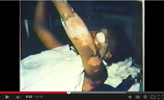1985 Ross Dress for Less Explodes Youtube snap 5 burn injury arms face Benita Harris