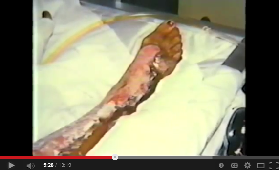 1985 Ross Dress for Less Explodes Youtube snap 4 burn injury Benita Harris