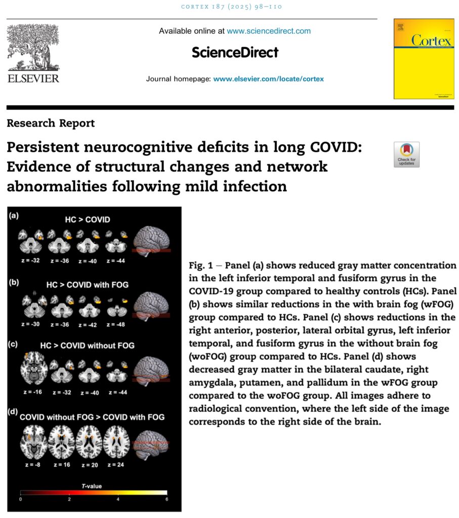 2025 06 snap of cover of study in Science Direct showing persistent neurocognitive deficits in long covid, structural changes, network abnormality after mild infection, with image of damages to brain