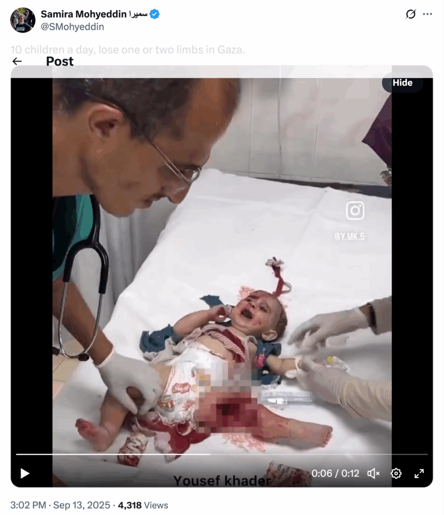 2025-09-13 tweet by Samira Mohyeddin 10 children a day lose 1 or 2 limbs in Gaza showing injured Palestinian baby crying with severe injury to a leg